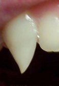 Vampire Fang Tutorial